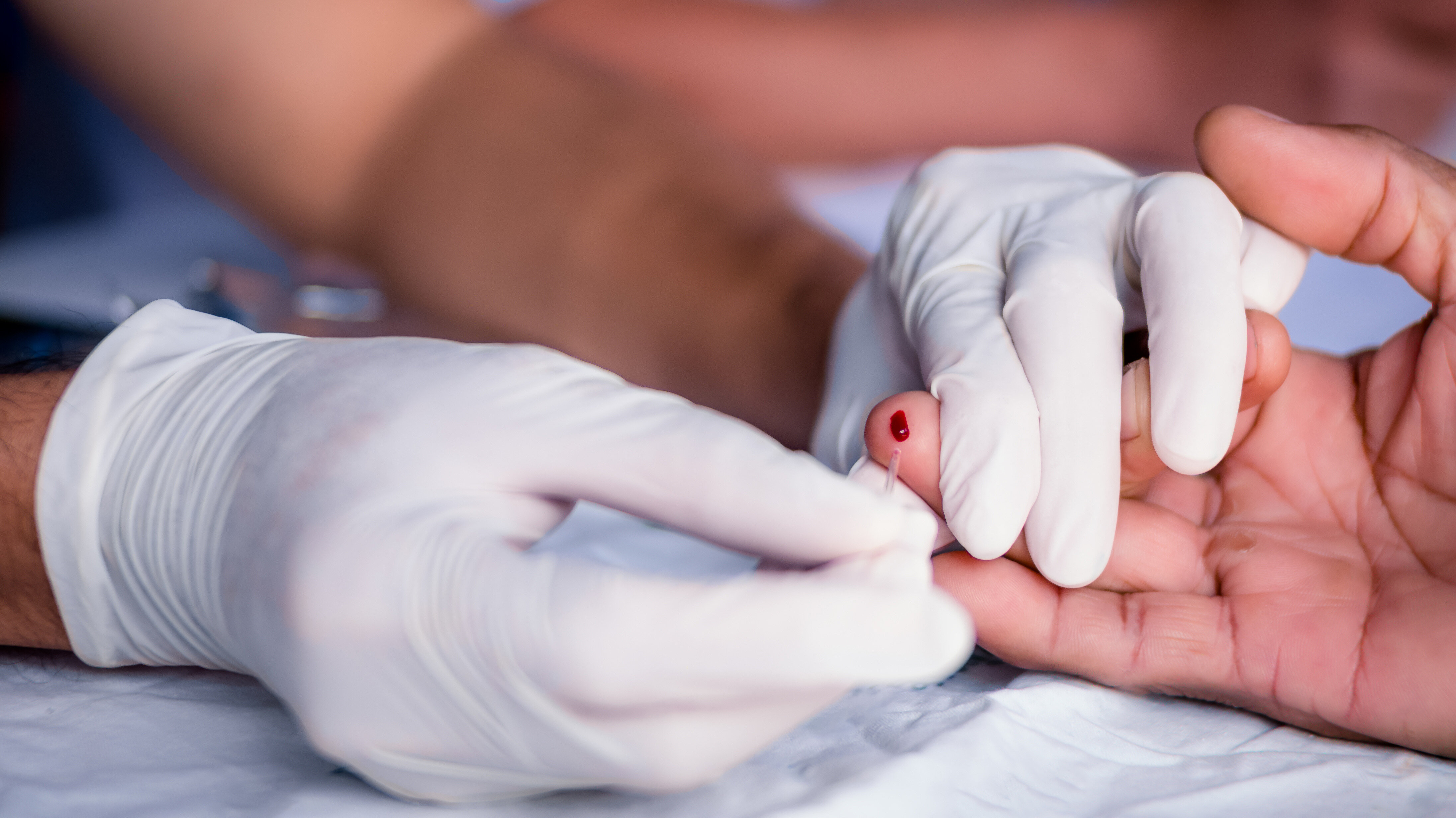 Nahaufnahme einer medizinischen Fachkraft mit Einmalhandschuhen, die mit einer Lanzette einen Tropfen Blut aus der Fingerspitze einer Person entnimmt. Im Hintergrund ist die Person unscharf auf einer Untersuchungsliege oder Behandlungsfläche zu sehen. Die Szene veranschaulicht eine Blutentnahme zur Diagnostik, beispielsweise für Blutzucker- oder Laboruntersuchungen.